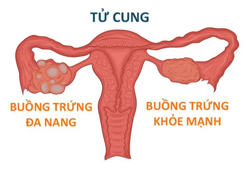 Đa nang buồng trứng: Nguyên nhân, triệu chứng, chẩn đoán & điều trị