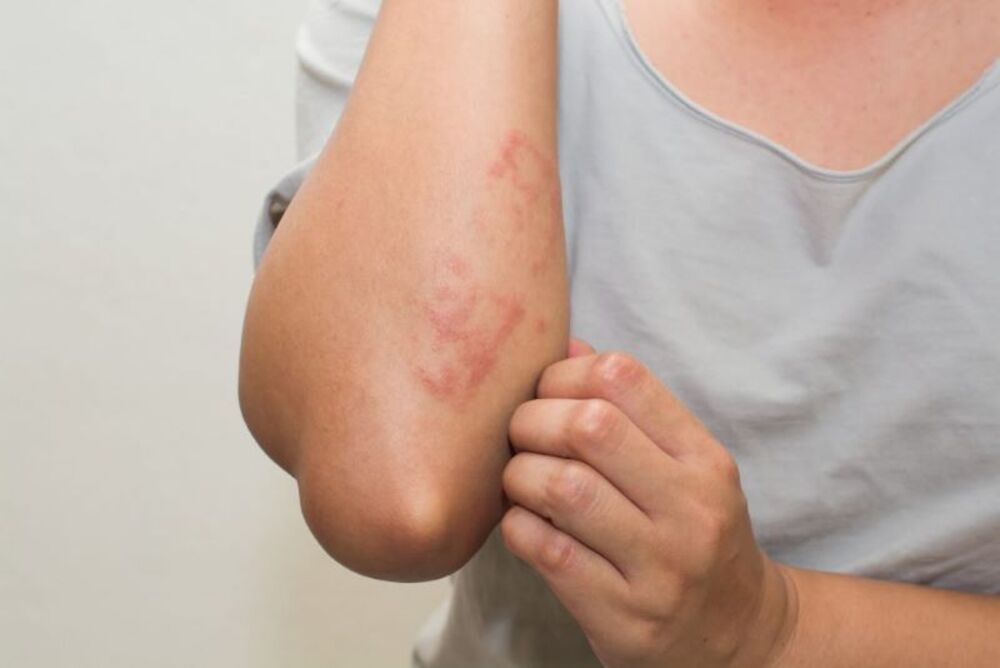 Thuốc nấm da có thể gây mẩn ngứa