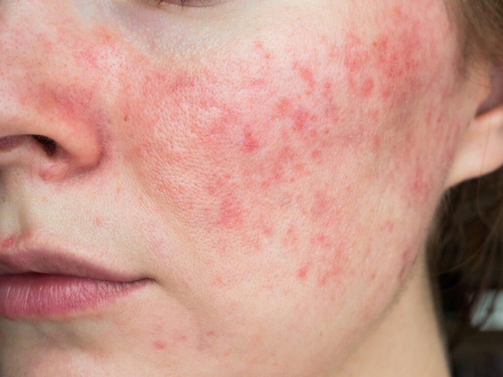 Da mặt nổi mẩn đỏ do dị ứng nguồn nước 
