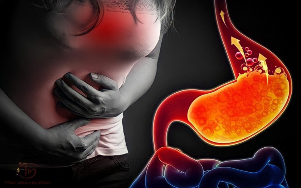 Trào ngược dạ dày gây viêm họng