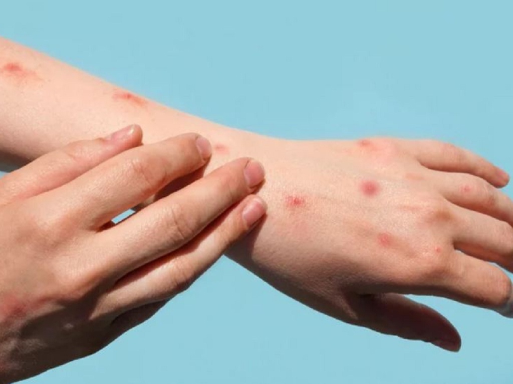 Đậu mùa khỉ lây qua đường nào? Phải làm gì khi bị lây nhiễm? 