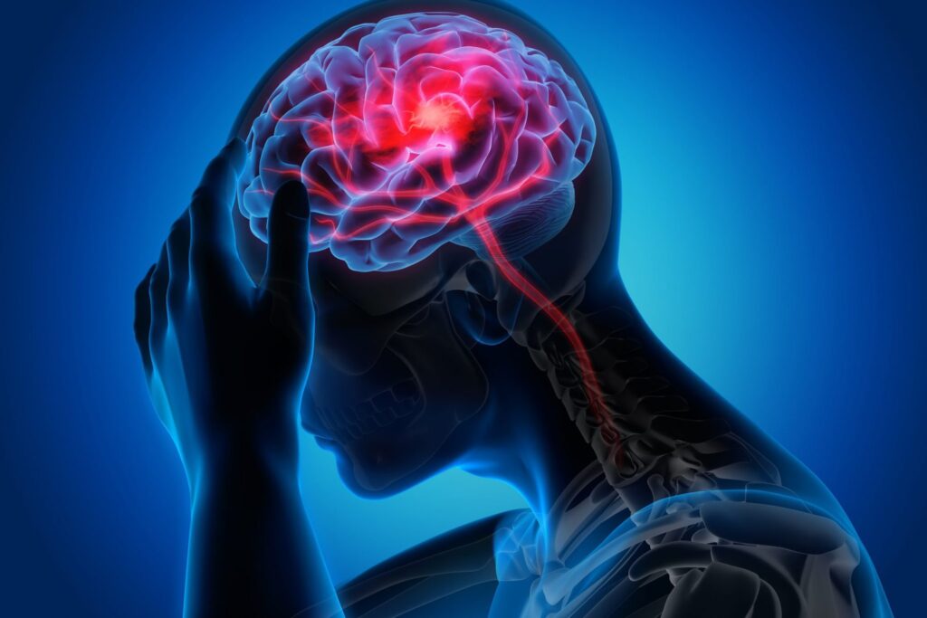 Đau đầu Migraine còn được biết đến với tên gọi là đau đầu vận mạch