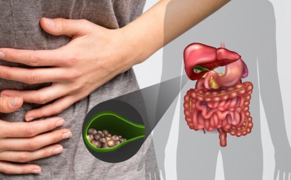 Triệu chứng của bệnh sỏi túi mật