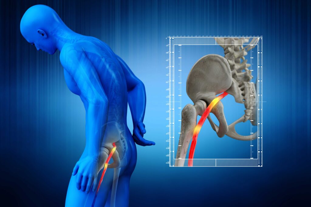Đau thần kinh tọa: Nguyên nhân, dấu hiệu, cách chẩn đoán và điều trị hiệu quả