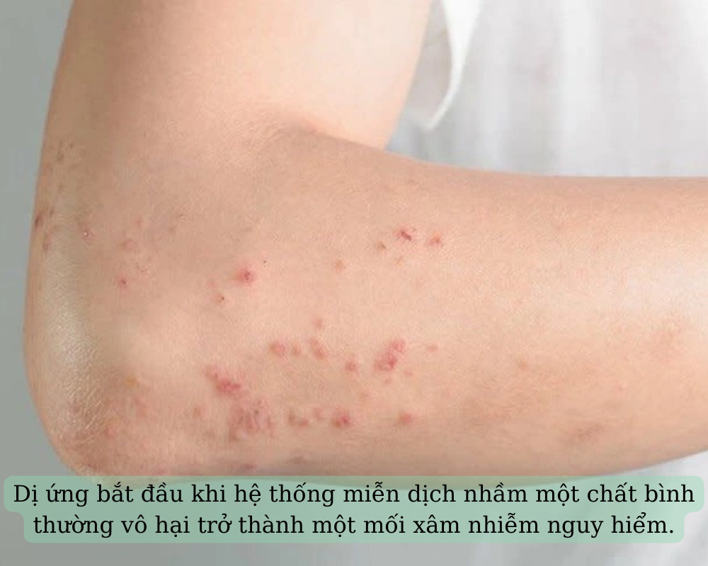 Dị ứng: Các loại dị ứng và triệu chứng thường gặp
