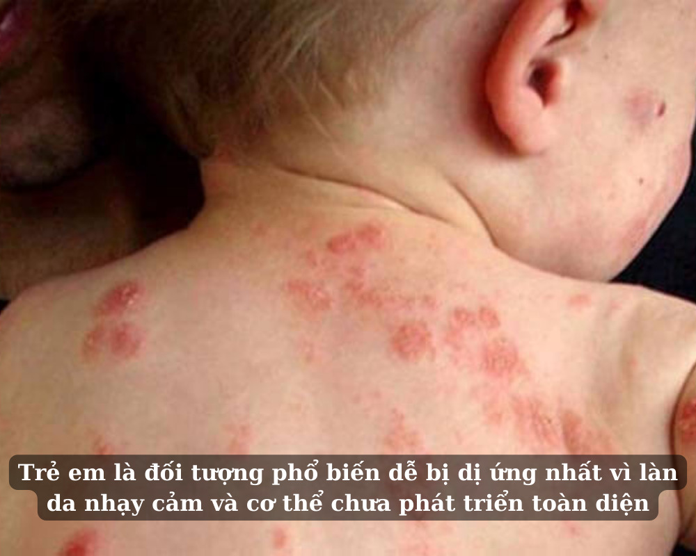 Ai cũng có thể bị dị ưng, đặc biệt trẻ nhỏ