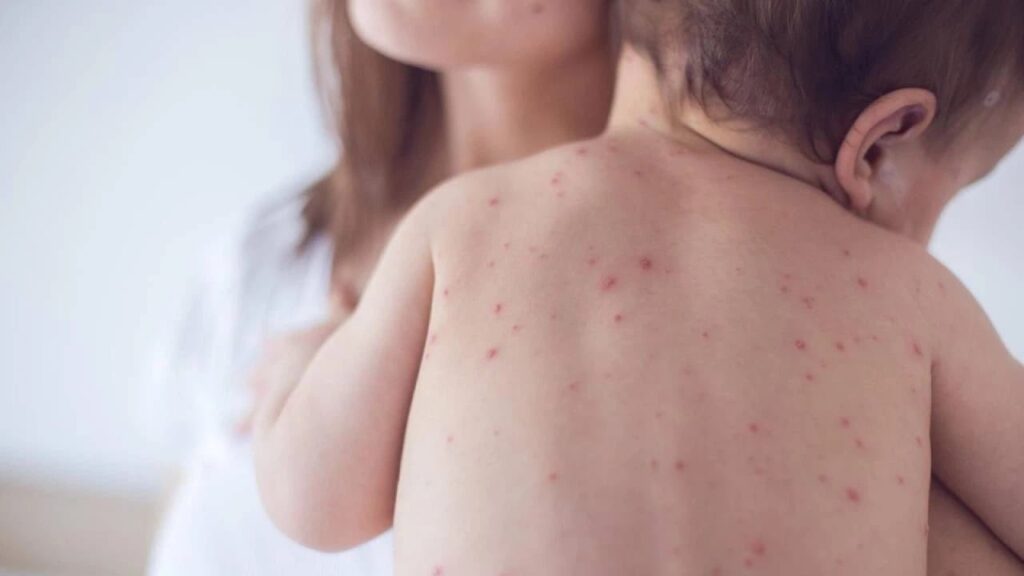 Dị ứng thời tiết: Nguyên nhân, triệu chứng và cách chữa trị