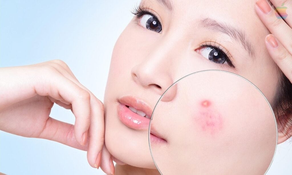 điều trị mụn