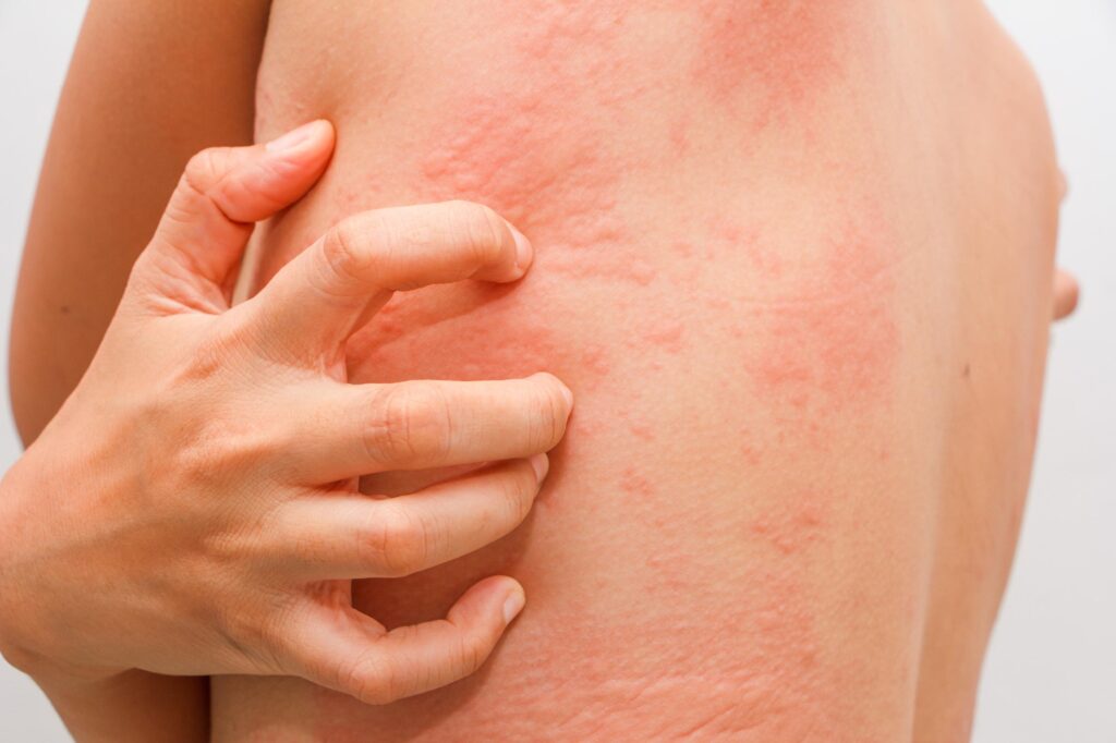 Điều trị nổi mề đay