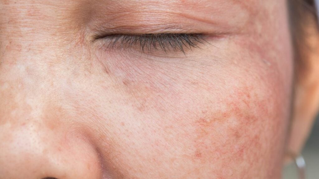 Đồi mồi trên da: Nguyên nhân & Cách điều trị