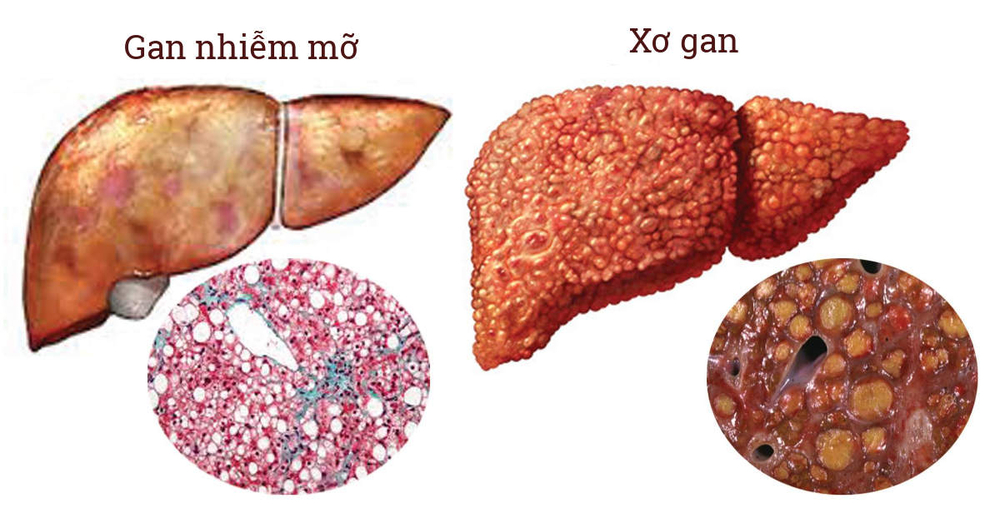 Gan nhiễm mỡ độ 1: Nguyên nhân, triệu chứng, cách điều trị