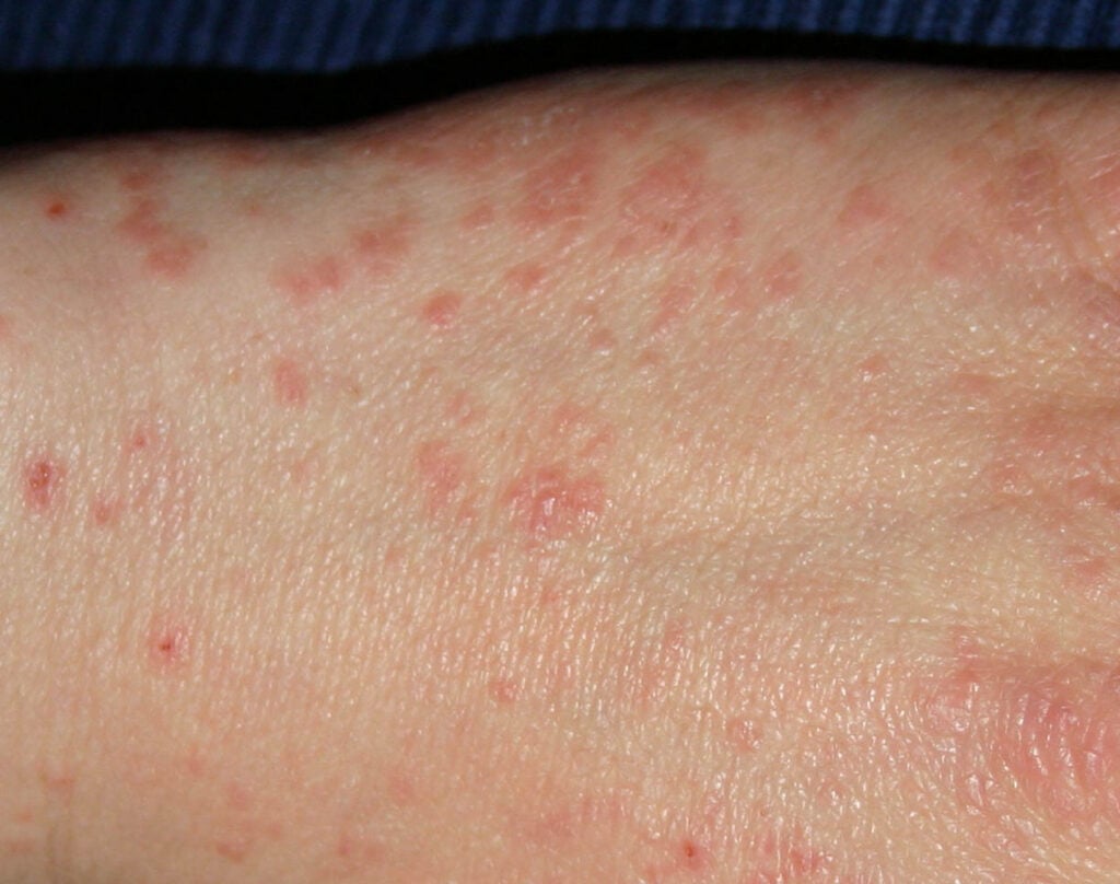 Ghẻ nước: Nguyên nhân, biểu hiện, cách trị dứt điểm