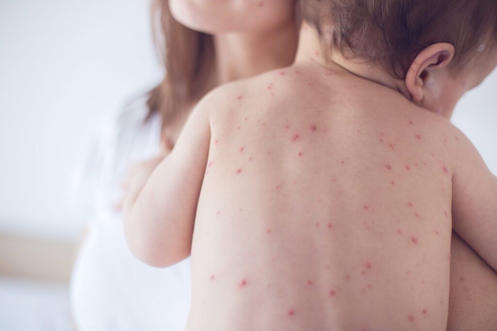 Triệu chứng sốt xuất huyết ở trẻ em và cách xử lý sớm