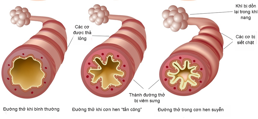 Bệnh hen suyễn: Nguyên nhân, dấu hiệu và cách điều trị