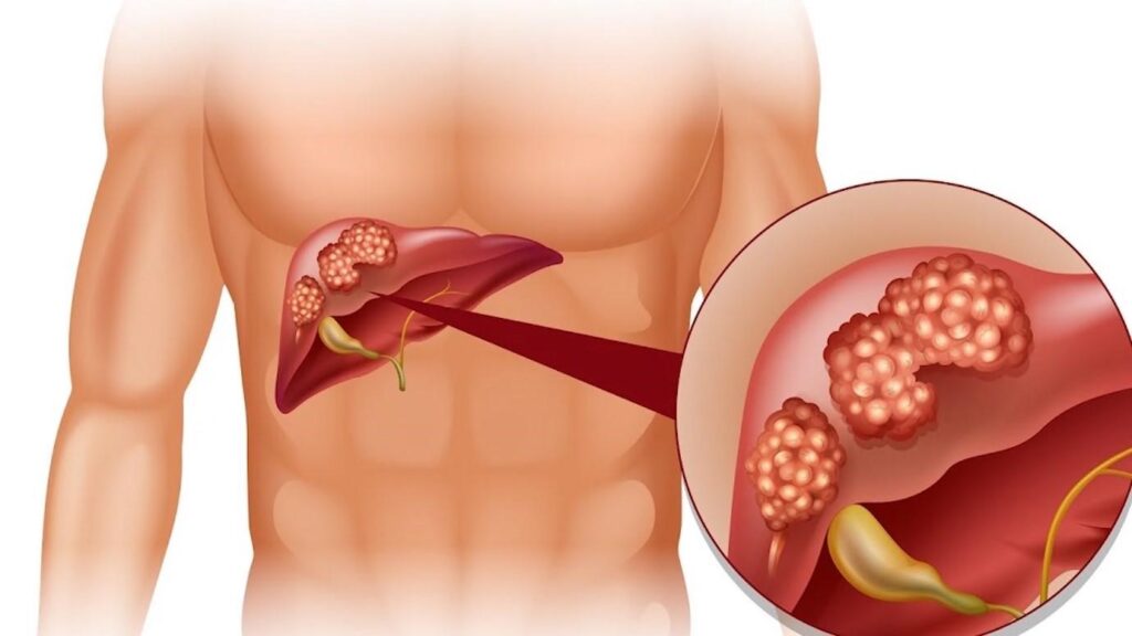 Cây bạch tuột hỗ trợ điều trị viêm gan virus 