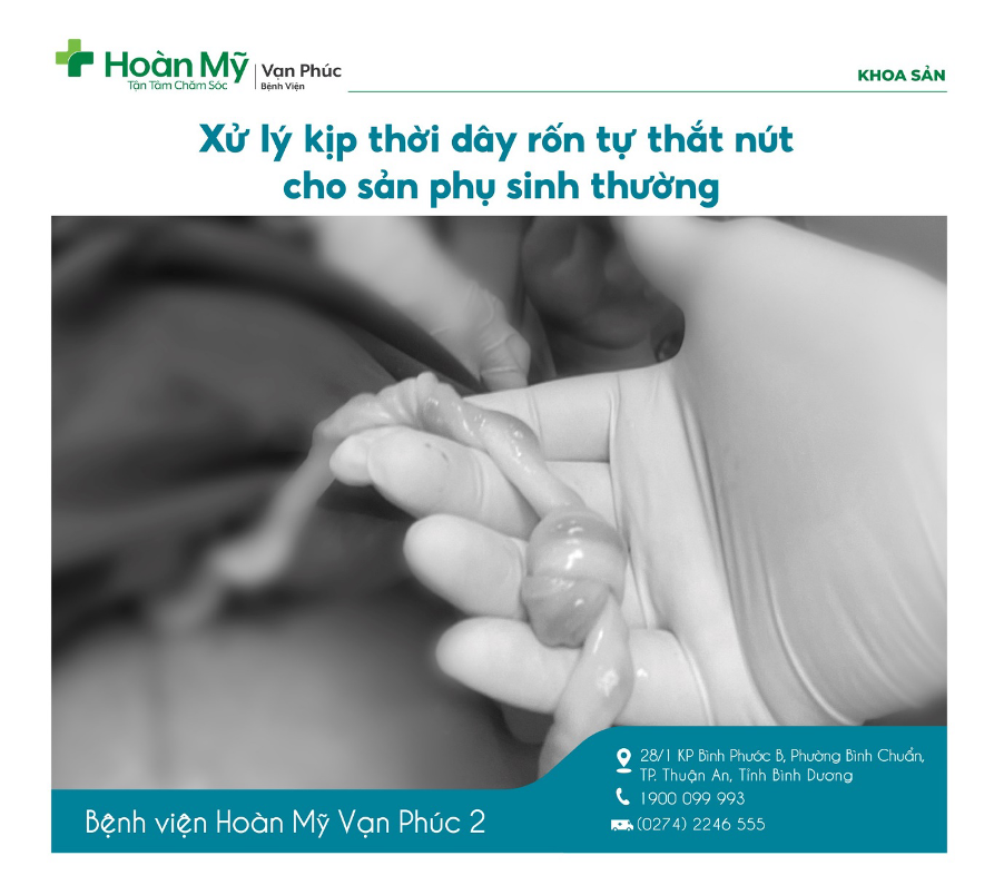 Xử lý kịp thời dây rốn tự thắt nút cho sản phụ sinh thường