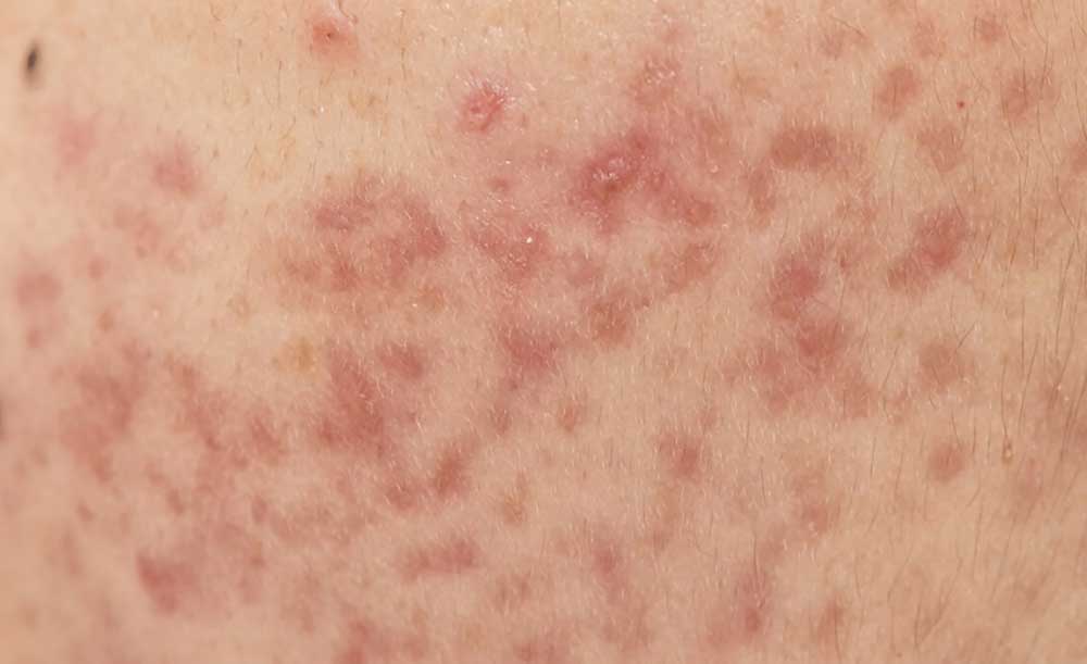 10 cách trị thâm mụn nặng hiệu quả nhanh nhất