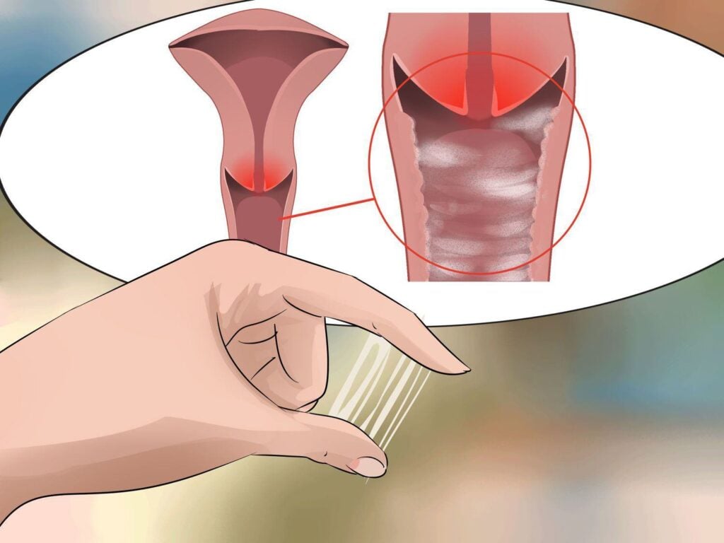 Khí hư bã đậu: Nguyên nhân, cách điều trị và biện pháp phòng ngừa