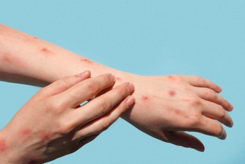 Bệnh thủy đậu ở trẻ em cần kiêng gì