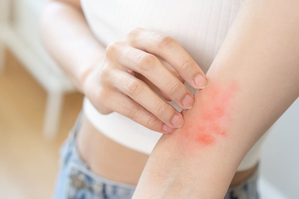 Loại hoa này có thể gây dị ứng da 