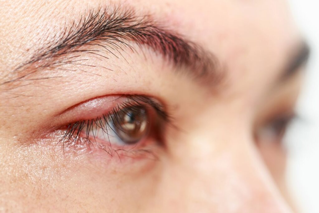 Lẹo mắt: Nguyên nhân, triệu chứng & cách điều trị