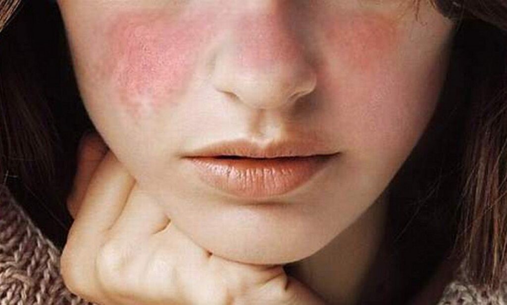 Lupus ban đỏ là gì? Nguyên nhân, triệu chứng và cách điều trị 