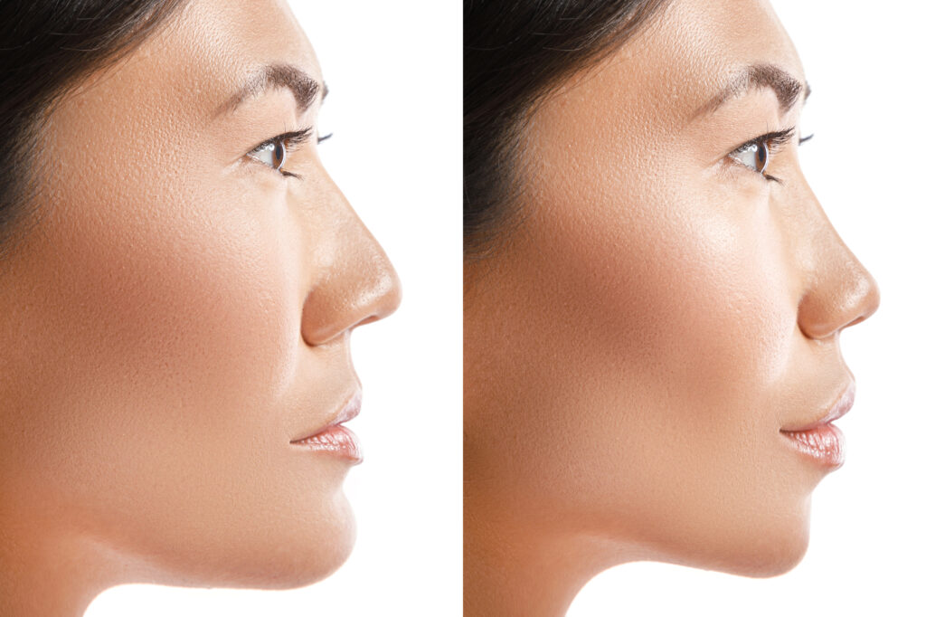Mewing là gì? Làm như thế nào? Tập mewing đúng cách cho người mới bắt đầu