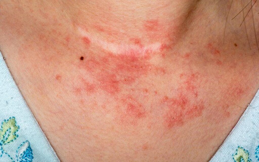 Viêm da dị ứng: Nguyên nhân, triệu chứng và cách điều trị