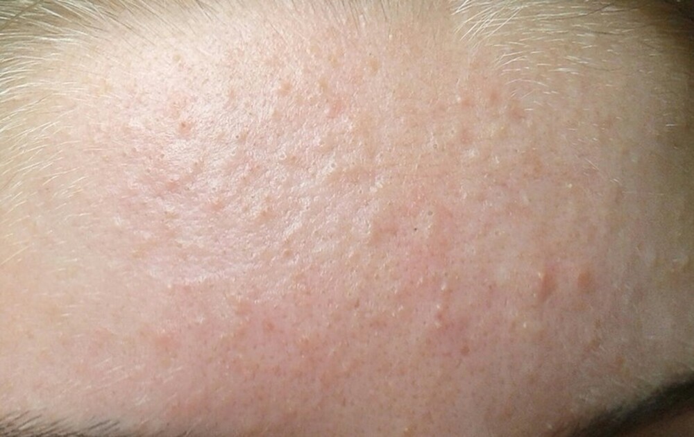 Mụn ẩn là gì? Cách trị mụn ẩn dưới da an toàn