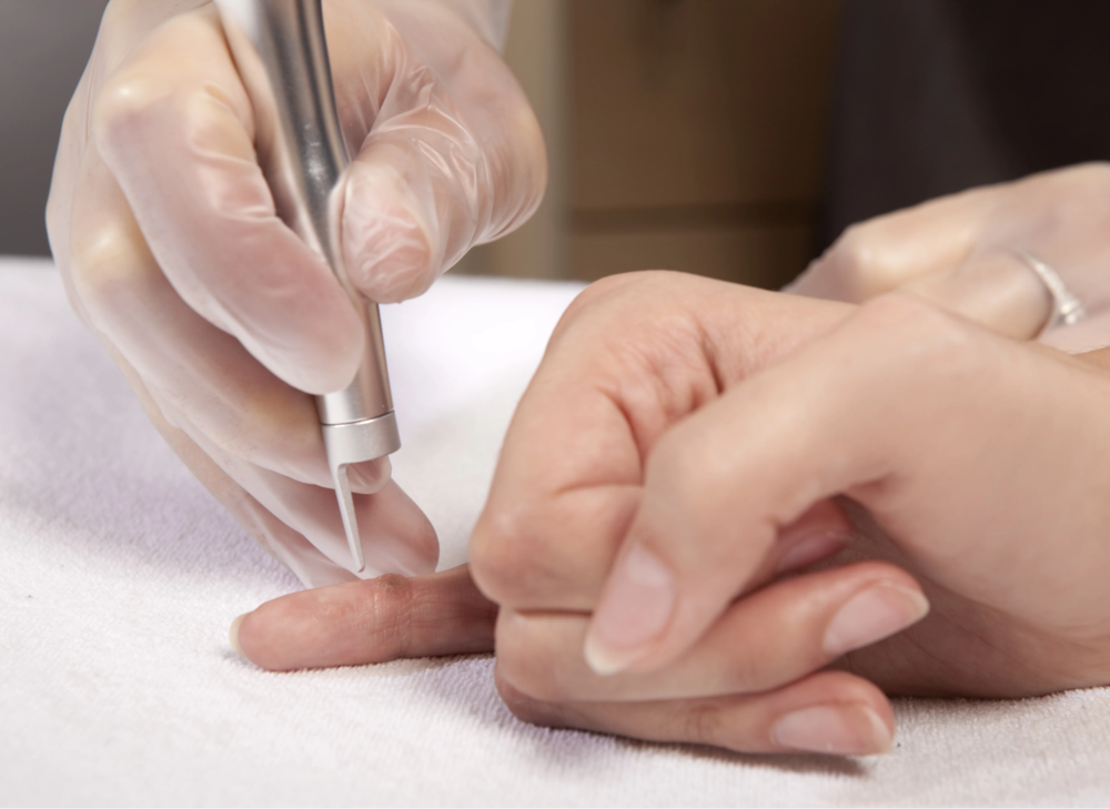 Điều trị mụn cóc bằng laser
