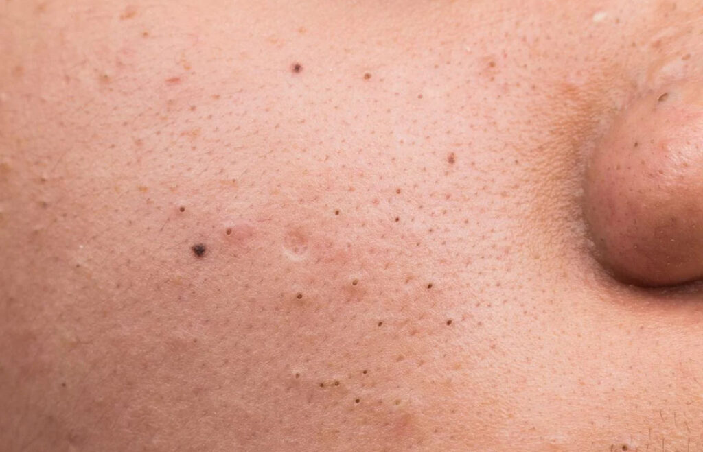 Mụn đầu đen: Nguyên nhân, cách điều trị và chăm sóc da