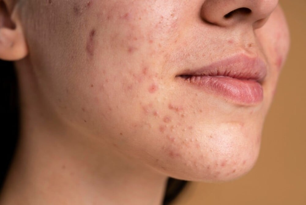 Phân biệt các loại mụn trên mặt và cách điều trị