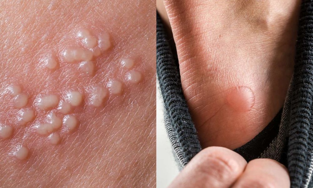 Mụn nước: Dấu hiệu, nguyên nhân và cách điều trị an toàn