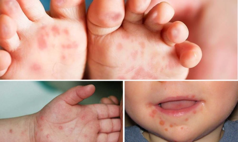 Mụn nước mọc ở tay, chân và miệng