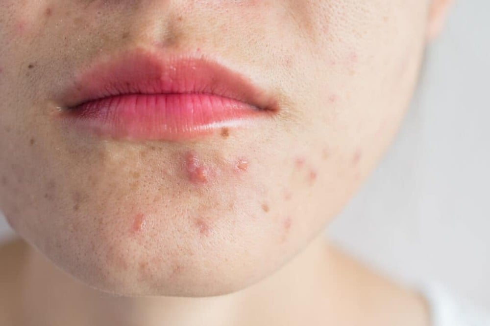 Mụn viêm là gì? Nguyên nhân, cách điều trị mụn viêm dứt điểm