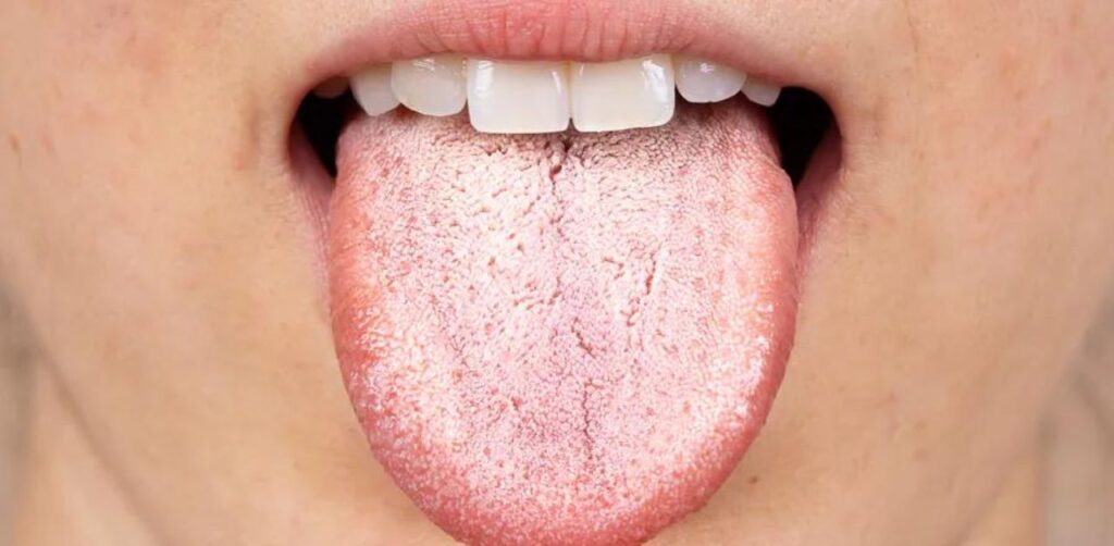 Bị nhiễm nấm Candida có chữa được không? Nguyên nhân & Cách phòng ngừa