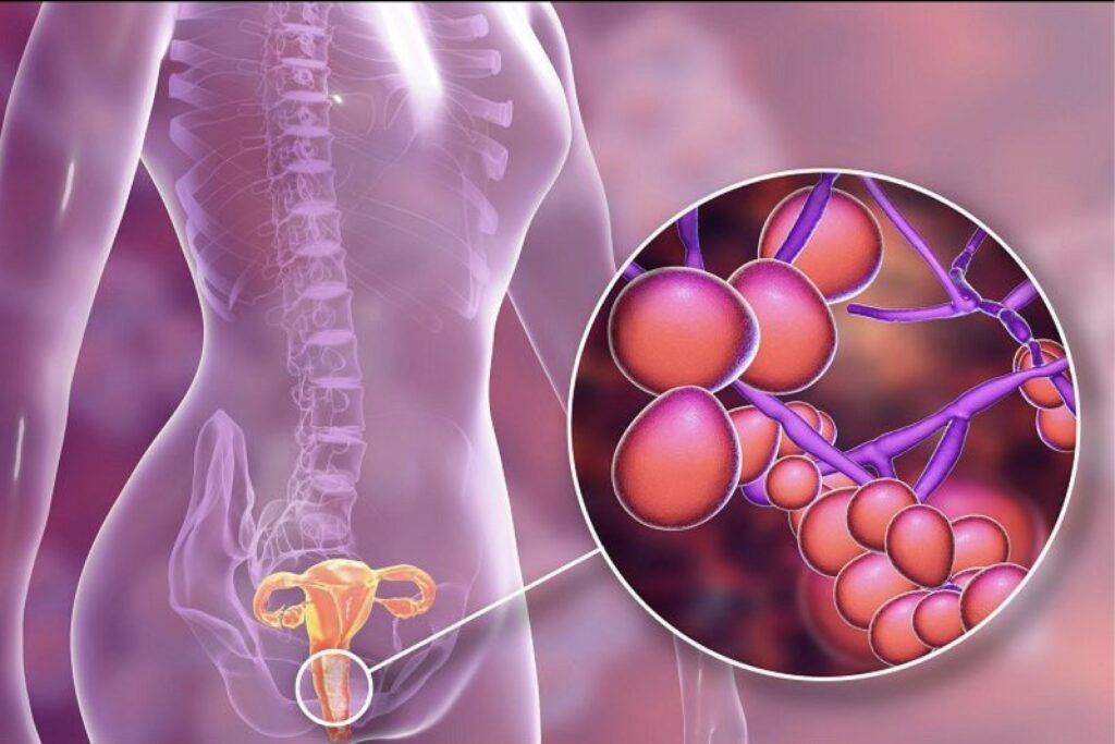 Viêm nhiễm âm đạo do nấm men