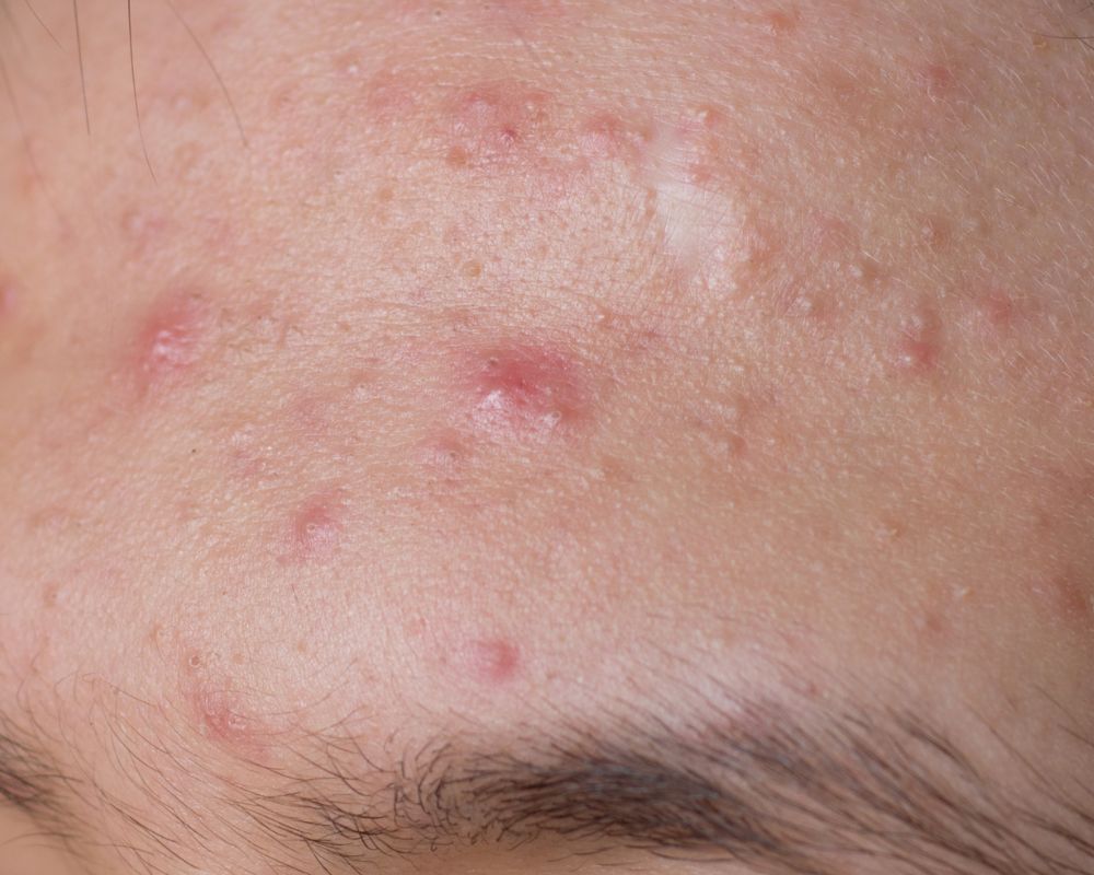 Top 8 nguyên nhân gây mụn bạn cần biết