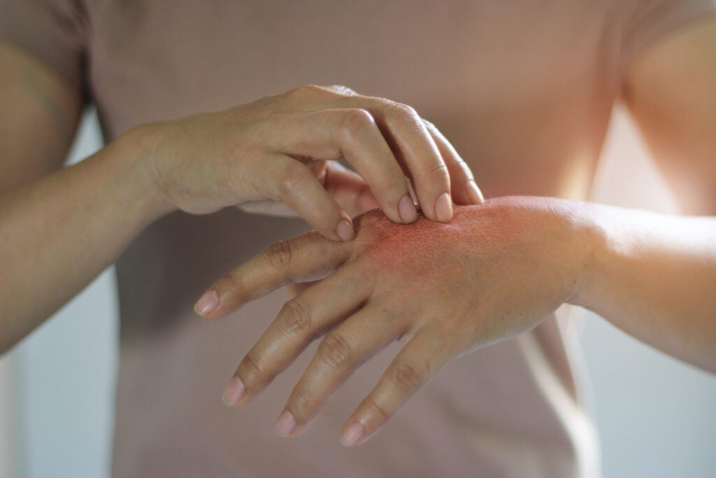 Nguyên nhân gây bệnh viêm da cơ địa