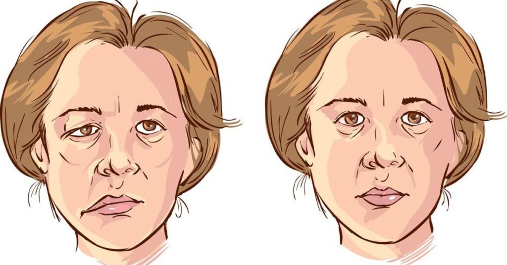 Liệt dây thần kinh số 7 là bệnh gì? Nguyên nhân & Cách điều trị