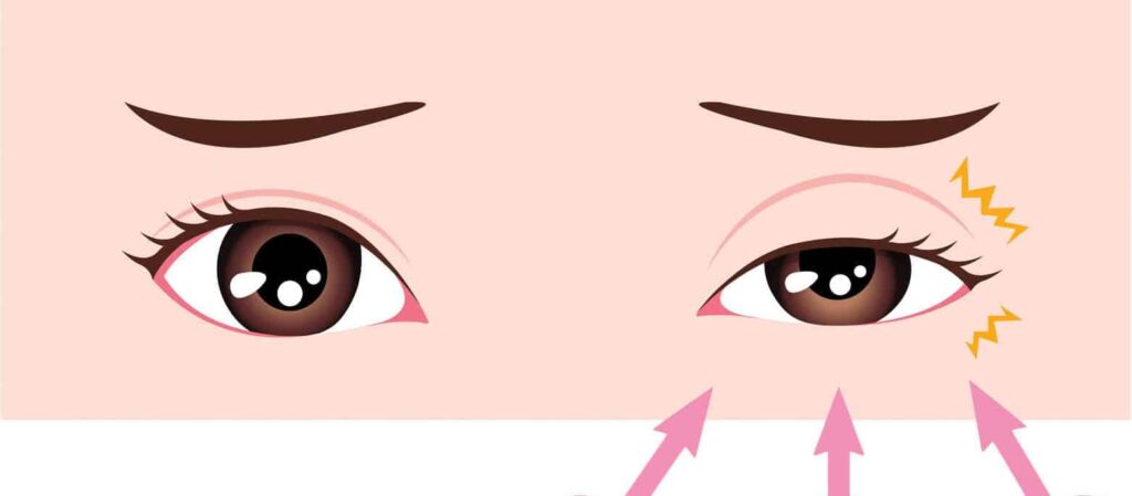 Mắt trái giật là điềm hay bệnh? Nguyên nhân và cách khắc phục
