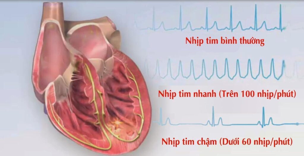 Giải đáp thắc mắc: Tim đập nhanh có nguy hiểm không?