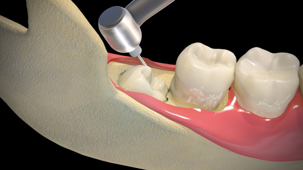 Răng số 8 mọc thẳng và khớp với hàm trên không nên nhổ