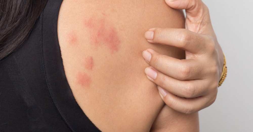 Da bị nổi mẩn đỏ: Nguyên nhân do đâu? Cách điều trị