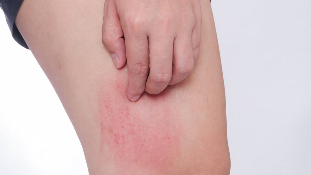Nổi mề đay: Nguyên nhân, triệu chứng và cách chữa mề đay an toàn
