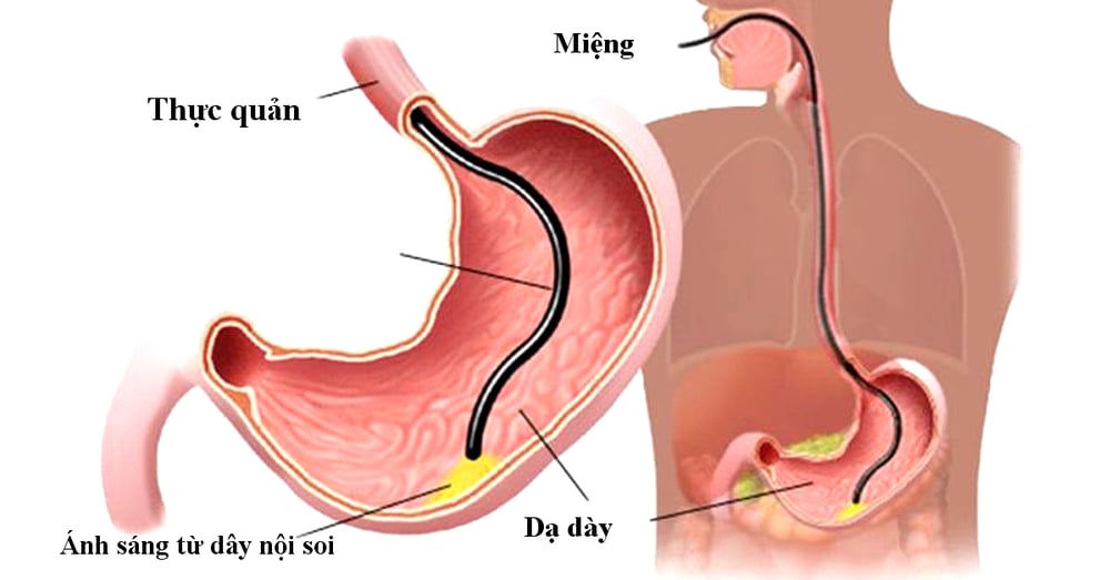 Có nên nội soi dạ dày gây mê? Một số lưu ý khi nội soi dạ dày