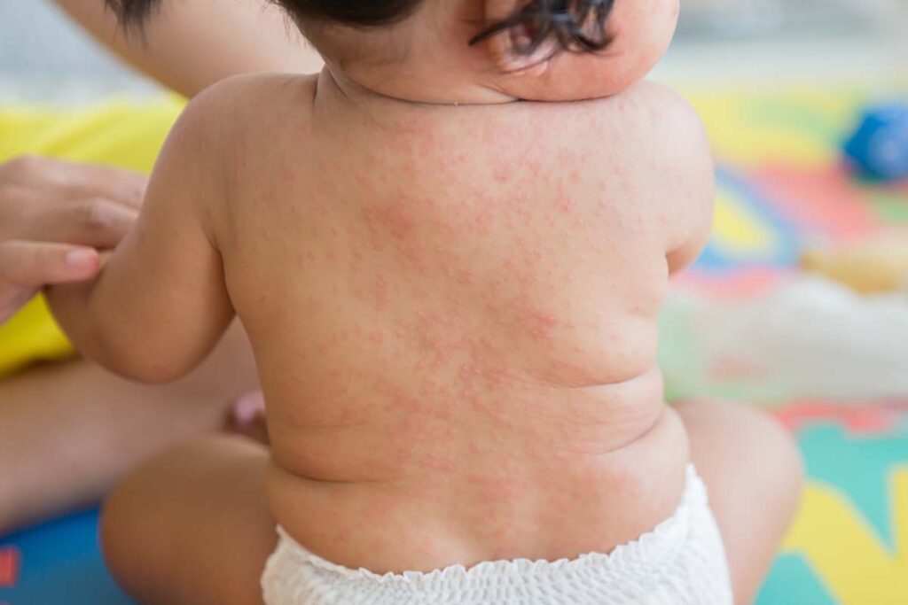 Bệnh ban đỏ nhiễm khuẩn có thể là nguyên nhân gây ra phát ban sau sốt 