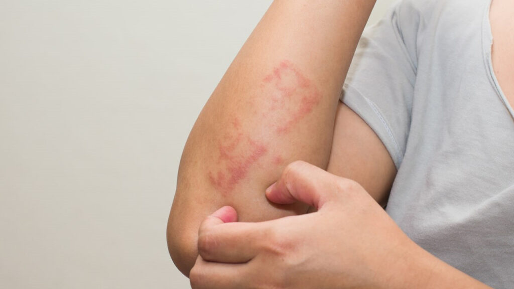 Phát ban HIV: Nguyên nhân, triệu chứng và cách xử lý bệnh