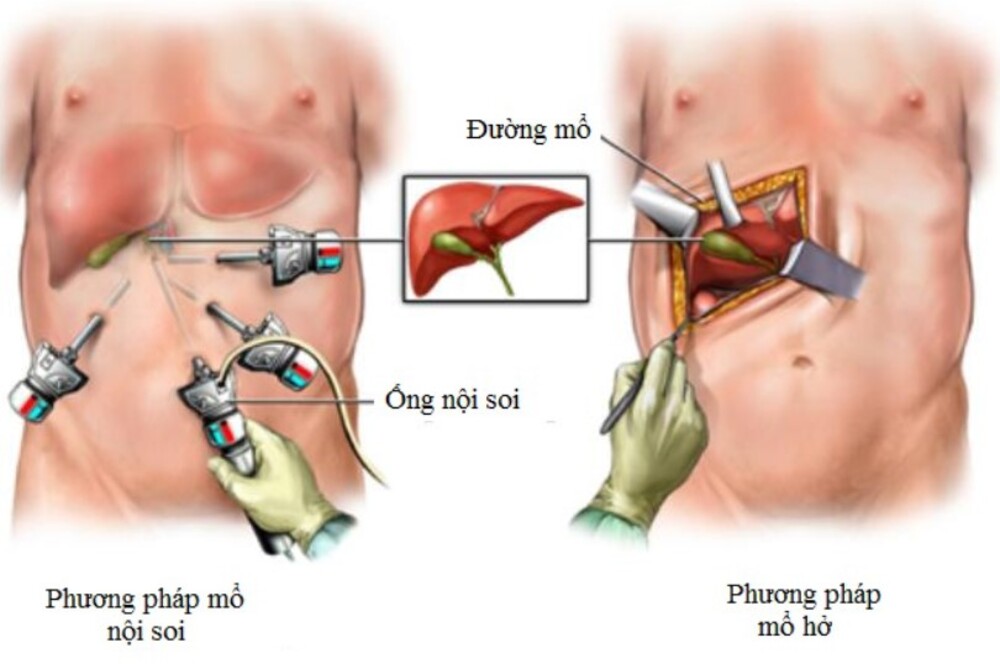 Phương pháp điều trị sỏi túi mật