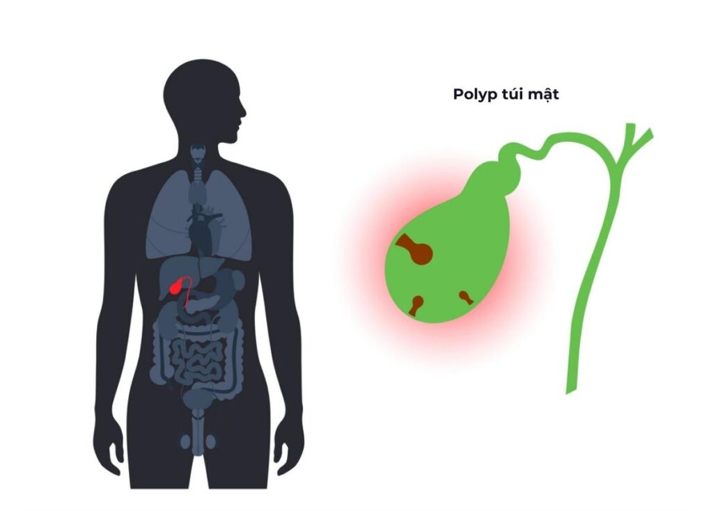 Polyp túi mật là gì? Nguyên nhân, triệu chứng, cách điều trị